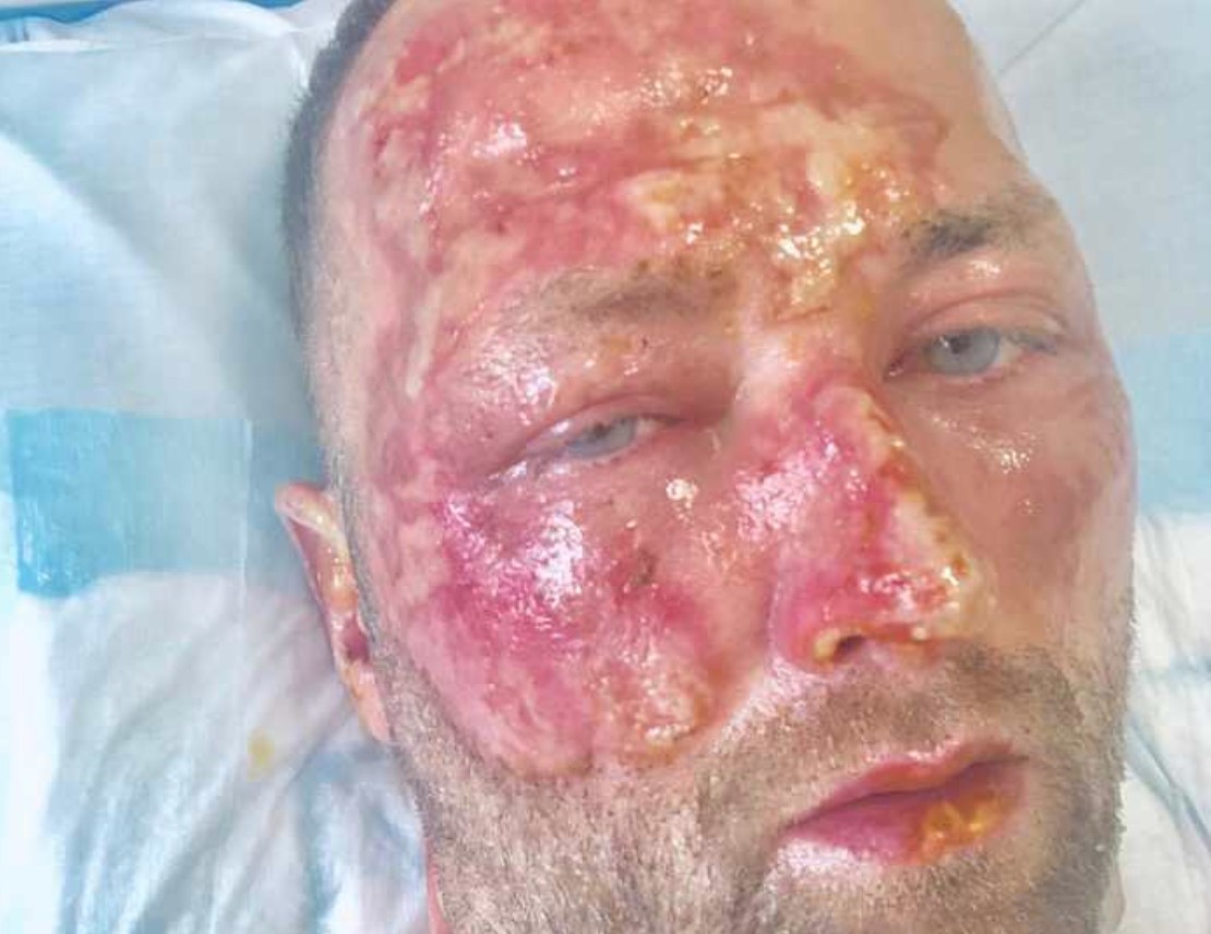 Un ancien joueur talentueux des Flames s'est fait brûler au visage