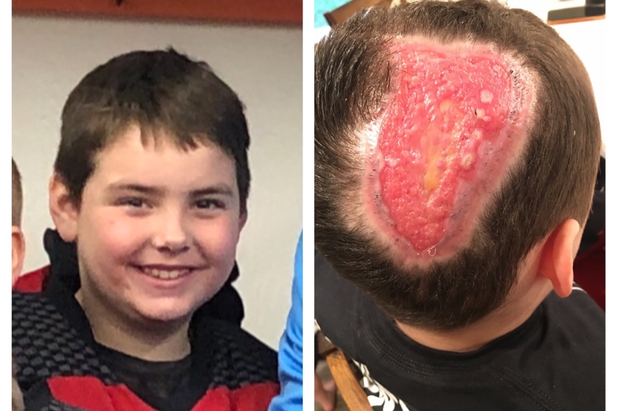 La triste histoire d'un jeune hockeyeur de 9 ans attaqué par un pitbull