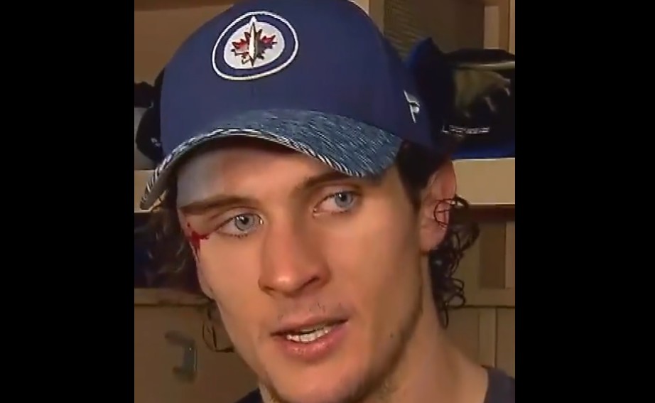 Quand 75 points de suture servent à inspirer les Jets de Winnipeg